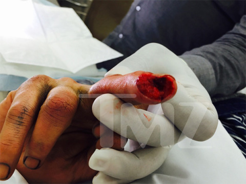 Johnny Depp cut finger