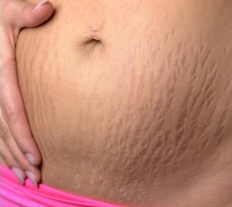 Stretch marks 