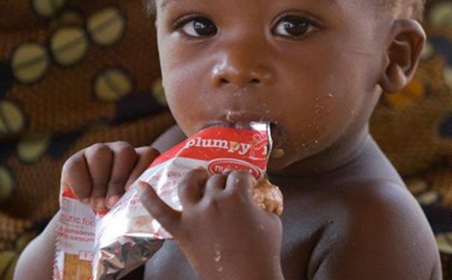children_suffering_severe_malnutrition