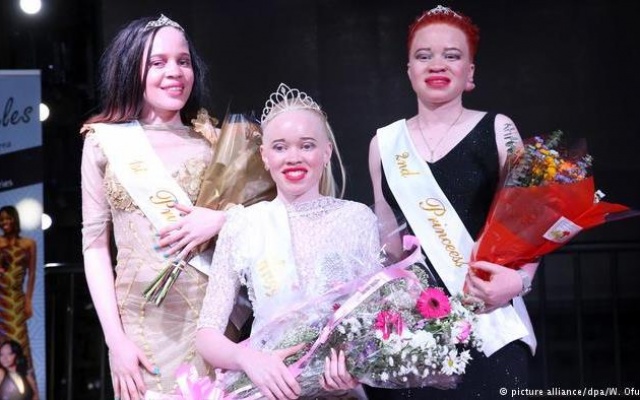 Albinism:_Zimbabwe_crowns_first_'Miss_Albino' 