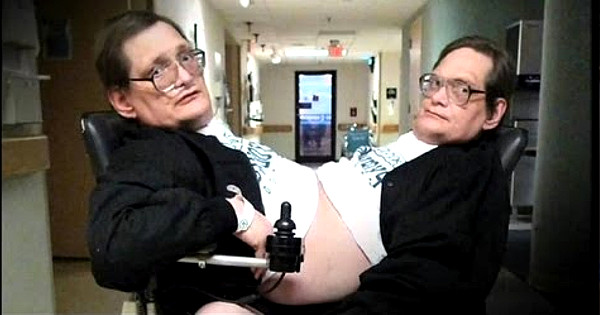 Siamese twins in vicious legal battle over right to masturbate