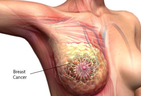 Here are 10 facts about breast cancer