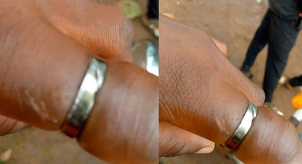 Promise ring almost cut off ladies finger overnight